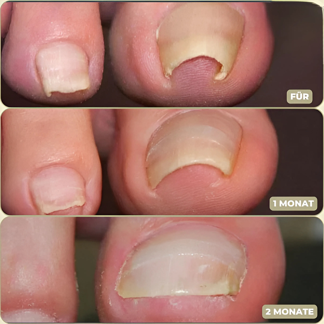 FixaNail Sofortige Nagelreparatur Patches – 25 + 25 Gratis