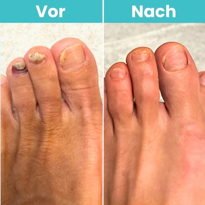 FungiClear Pro™ – Lasergerät gegen Nagelpilz