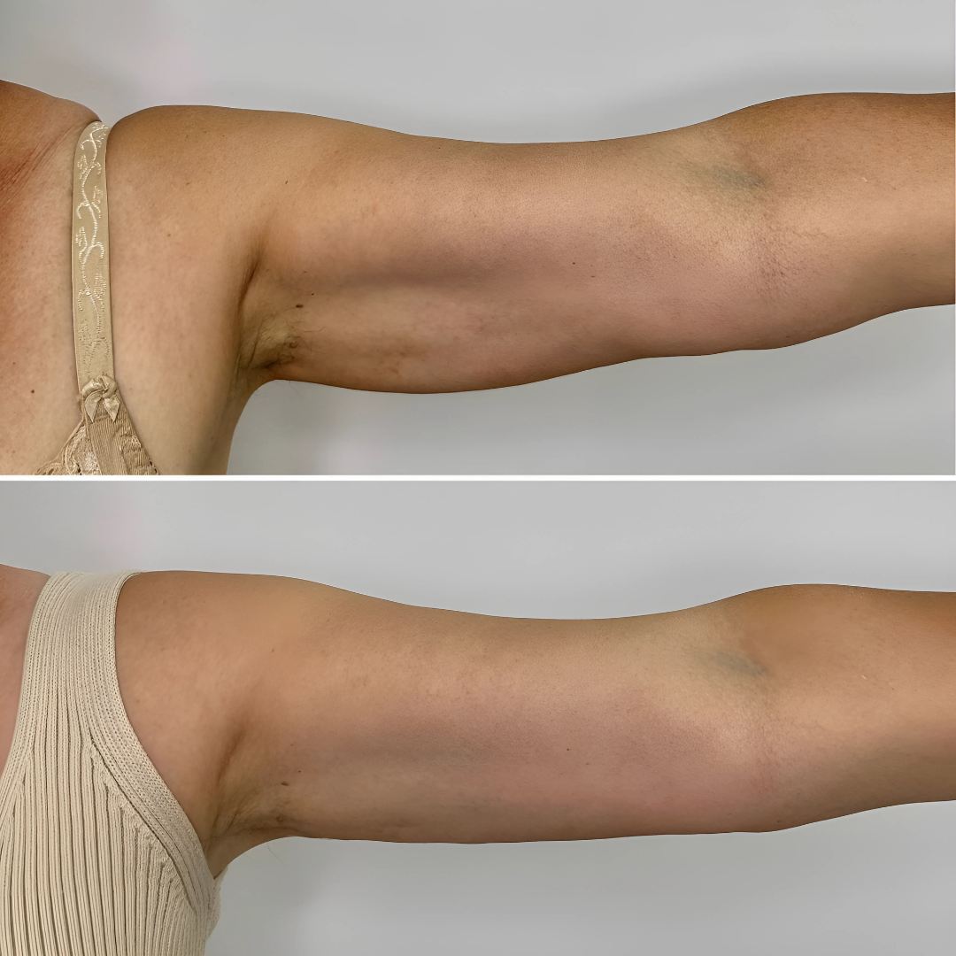 Sérum raffermissant bras & jambes