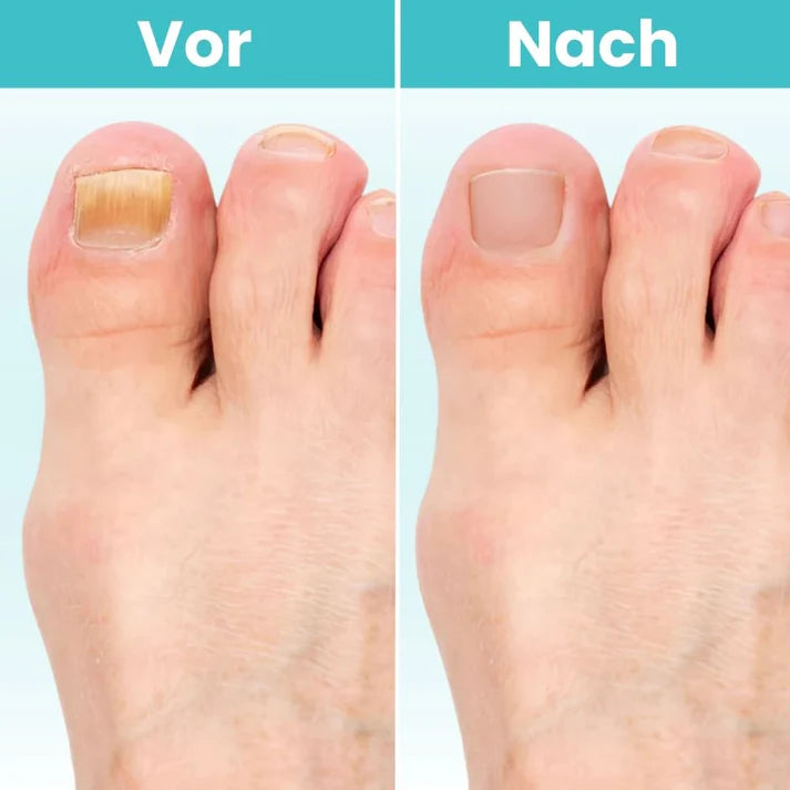 FungiClear Pro™ – Lasergerät gegen Nagelpilz