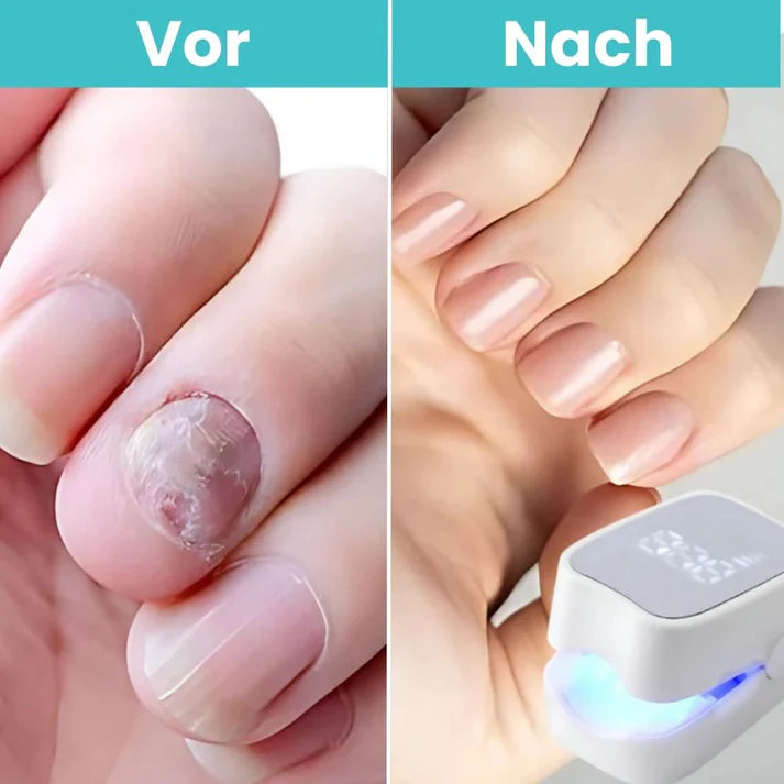 FungiClear Pro™ – Lasergerät gegen Nagelpilz