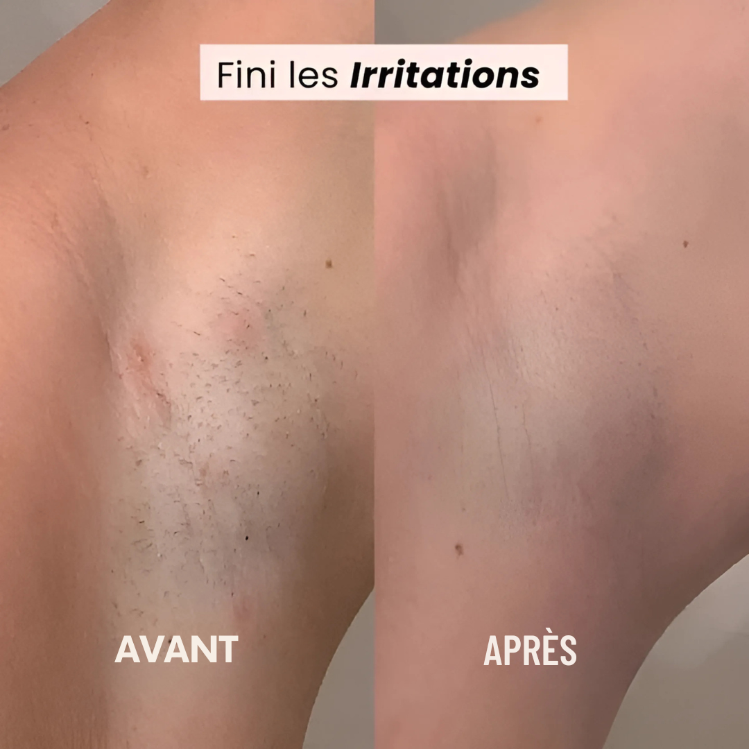 Épilateur électrique sans douleur