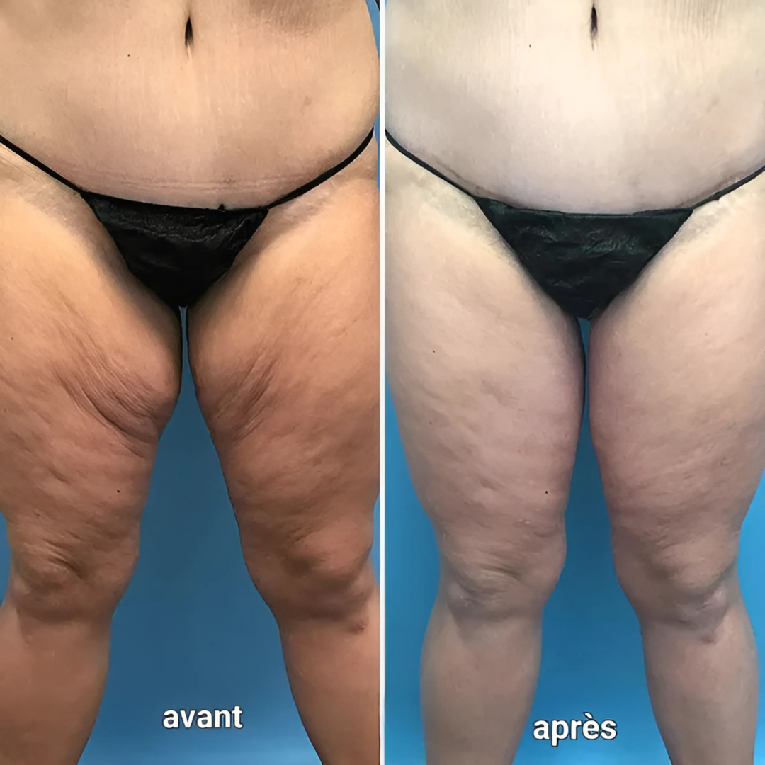 Sérum raffermissant bras & jambes