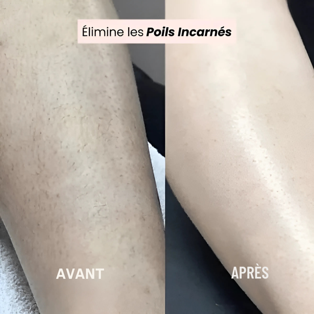 Épilateur électrique sans douleur