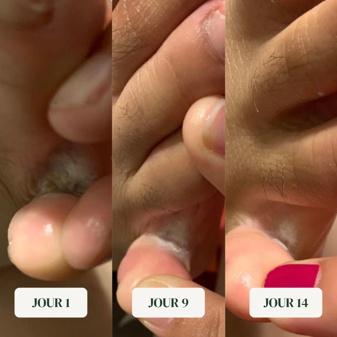 Savon anti-mycoses pieds