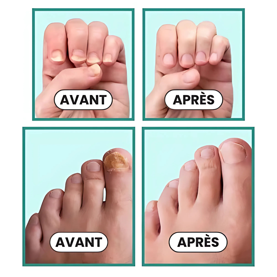 Traitement Lumineux pour Ongles Abîmés