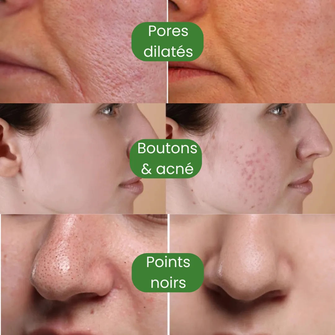 Masque Nettoyant Anti-Points Noirs