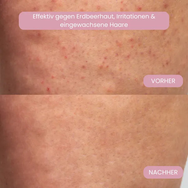 Haarentfernungs-Set ohne Reizungen