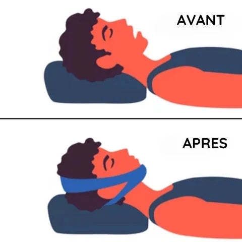 SangleFlowâ„¢ - Sangle Mâchoire