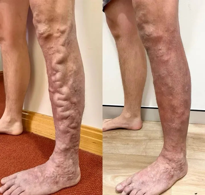 Spray contre les varicosités & varices