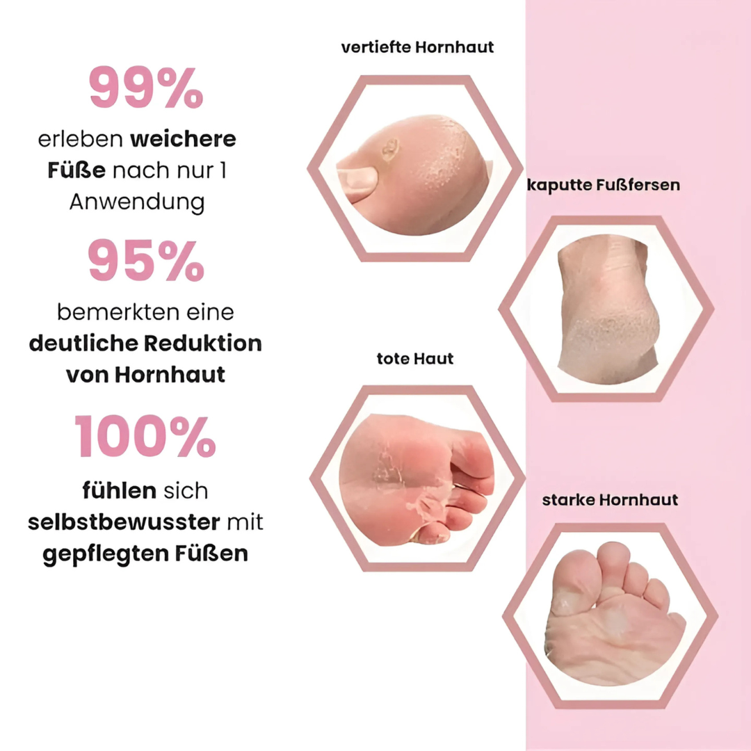 Elektrischer Hornhautentferner für sanfte Fußpflege (fornitore di trombe elettriche)