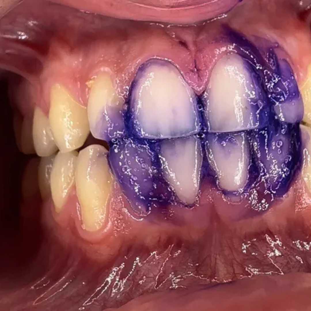 Zahngel a struttura fissa