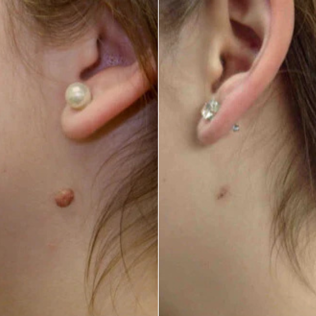 MyPeau™ Niente più Acrochordon!