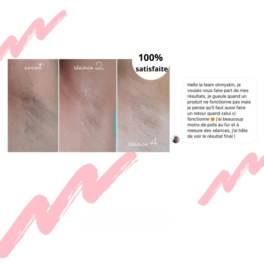 Epilatore a luce pulsata intensa