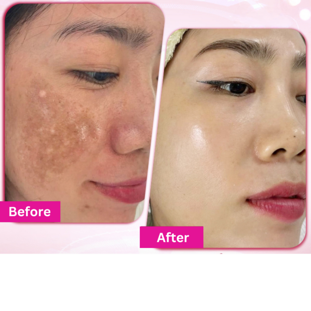 Crema anti-macchie e melasma