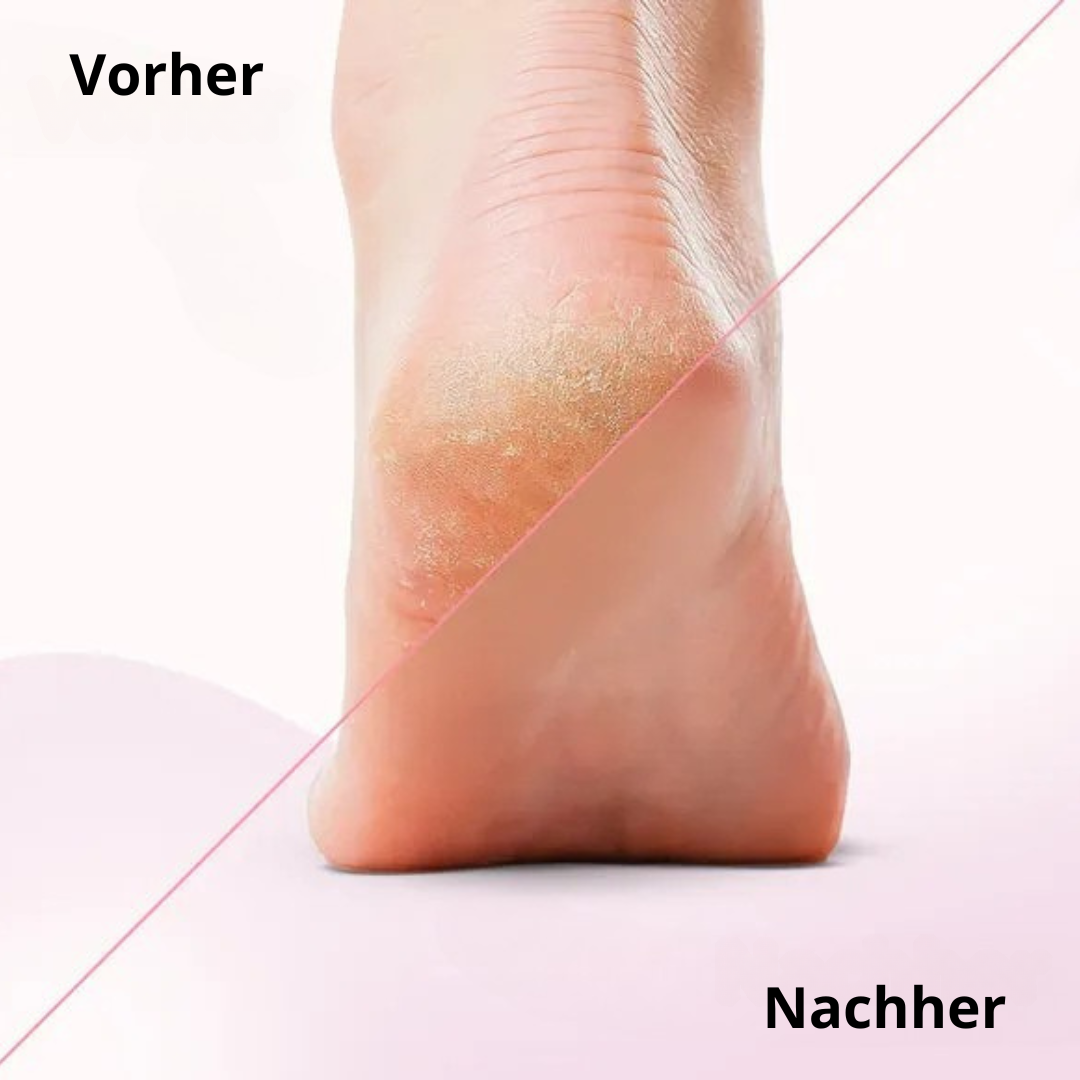 Elektrischer Hornhautentferner für weiche Füße (fornitore di trombe elettriche)