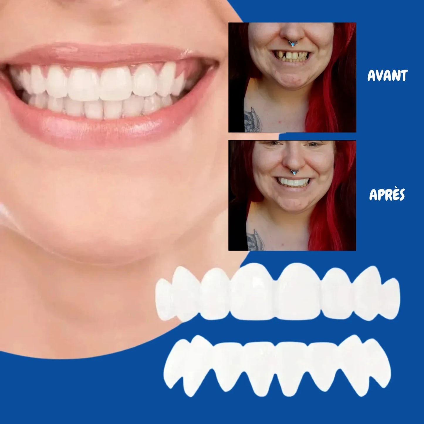 Faccette dentali flessibili a clip - Sorriso immediato e senza dolore
