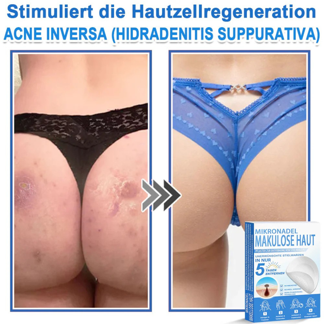 Patchs micro-aiguilles anti-boutons et imperfections visage