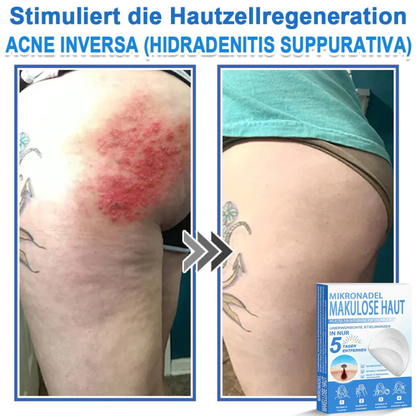 Patchs micro-aiguilles anti-boutons et imperfections visage