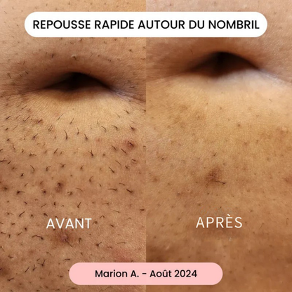 Sanfter elektrischer Epilierer