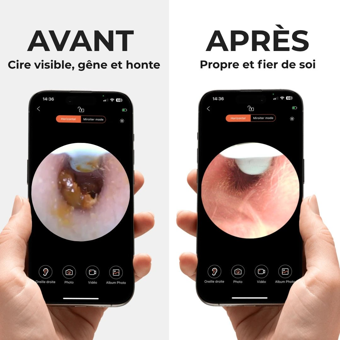 Otoscope Connecté Caméra HD
