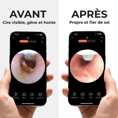 Otoscope Connecté Caméra HD