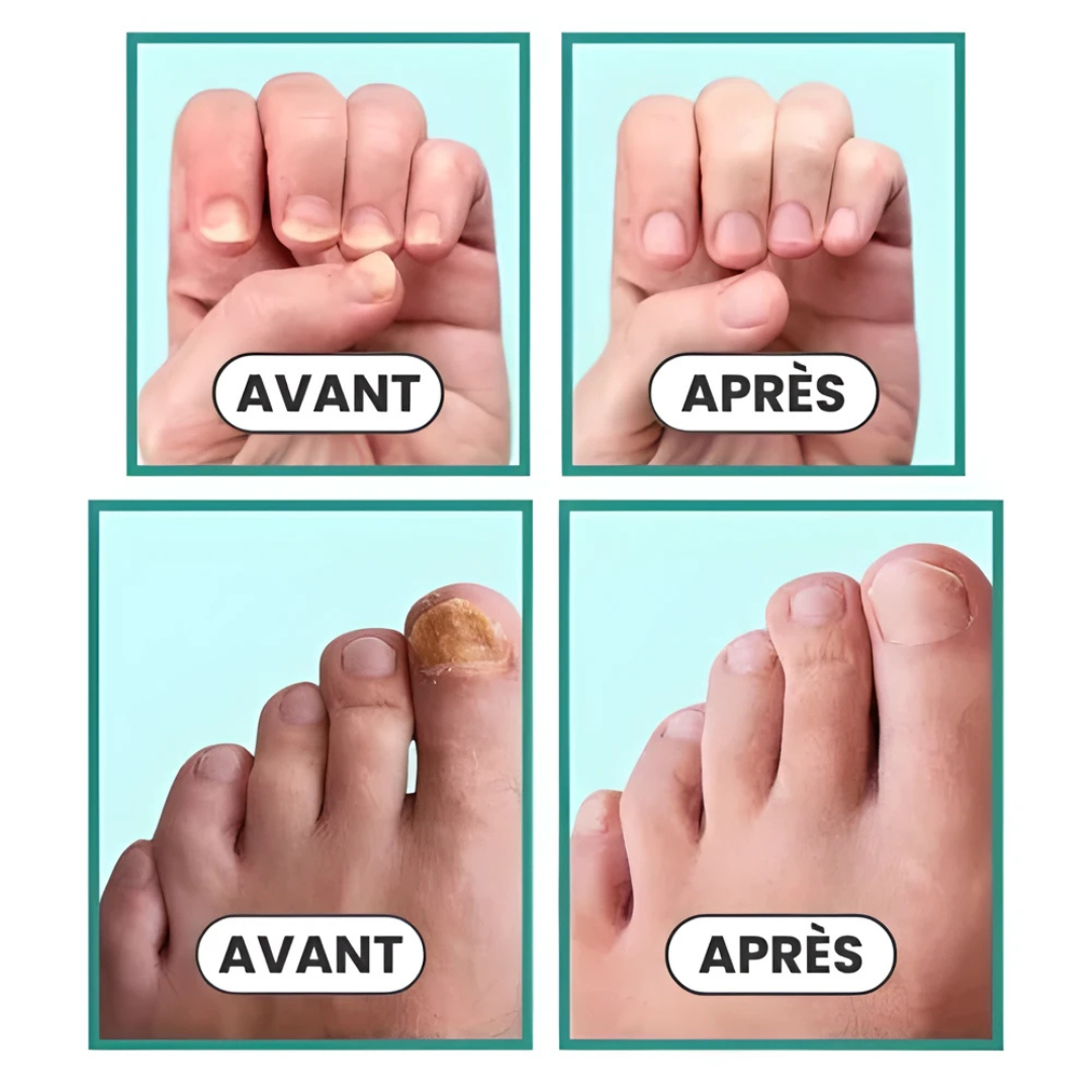 Appareil anti-mycose ongles