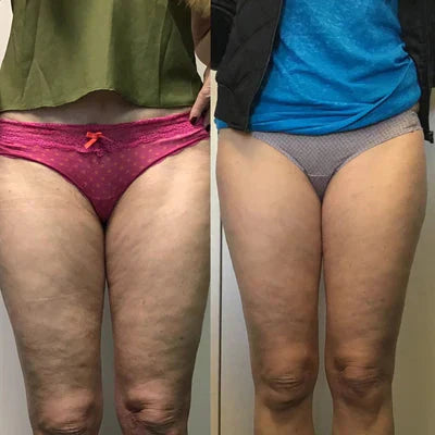 Beheiztes Anti-Cellulite-Gerät