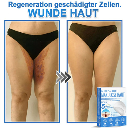 Patchs micro-aiguilles anti-boutons et imperfections visage