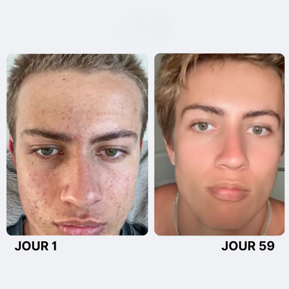 Savon Purifiant Anti-Acné