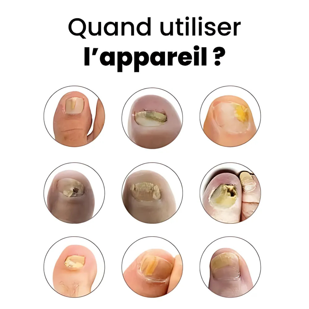 Appareil anti-mycose ongles