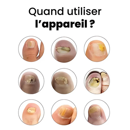 Appareil anti-mycose ongles