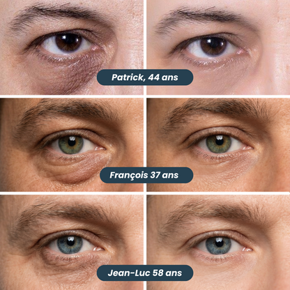 Anti-Augenringe-Patches mit Mikronadeln