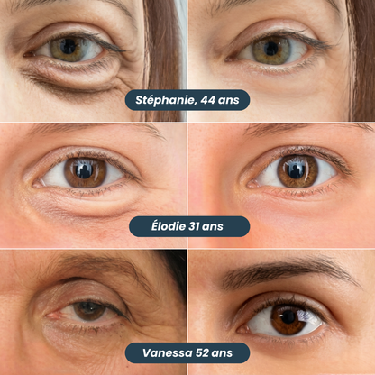 Anti-Augenringe-Patches mit Mikronadeln