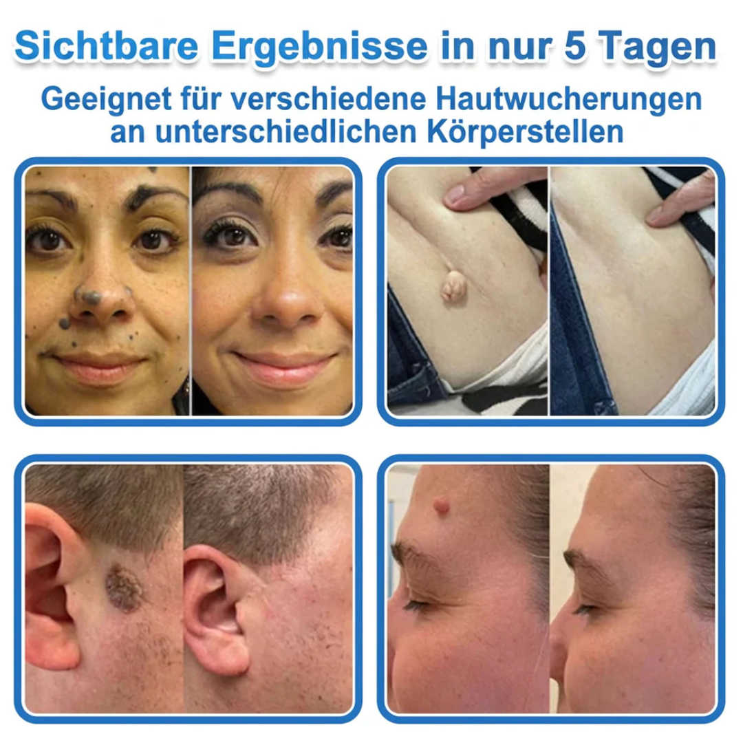 Patchs micro-aiguilles anti-boutons et imperfections visage