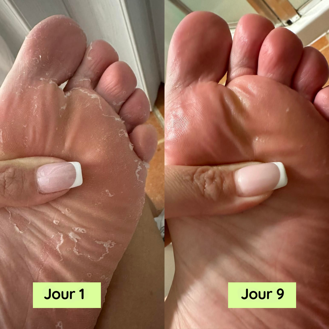 Savon Anti-Mycoses à l'Huile d'Arbre à Thé