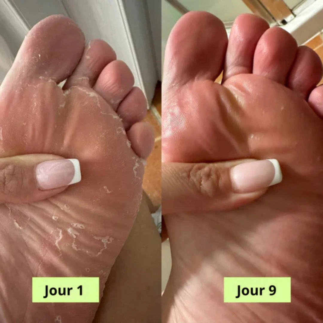 Savon Antifongique