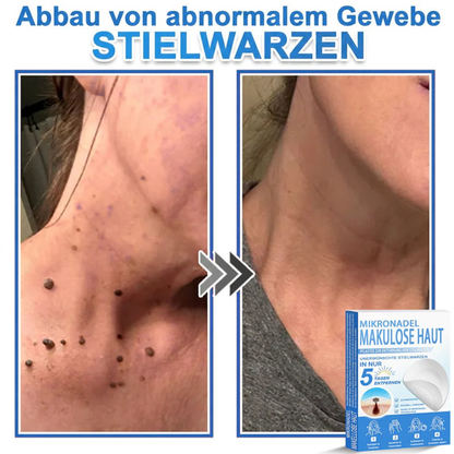 Patchs micro-aiguilles anti-boutons et imperfections visage