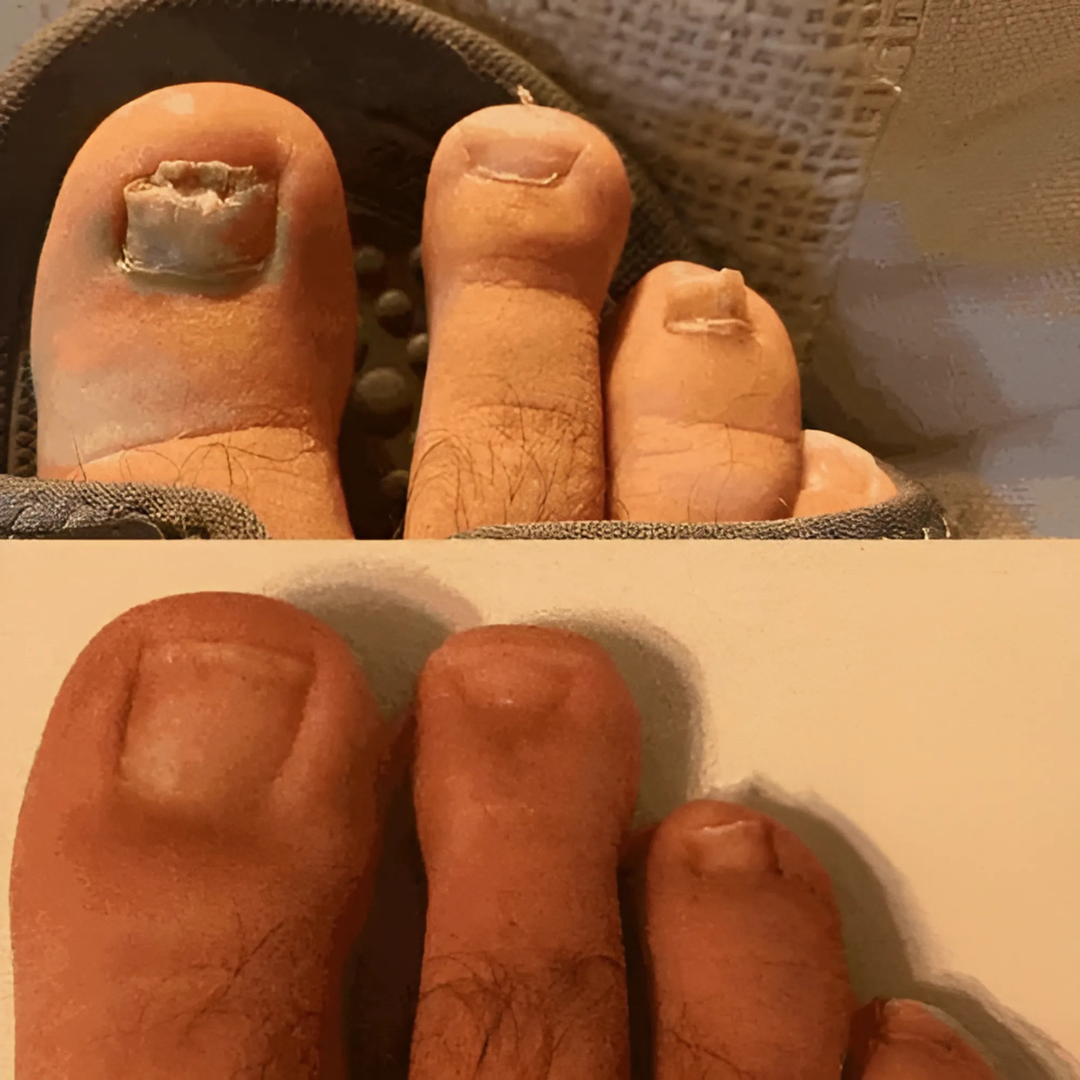 Dispositif LED anti-mycose ongles – Soins rapides et naturels