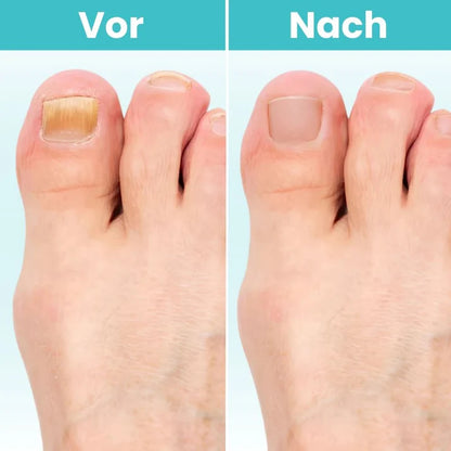 FungiClear Pro™ – Lasergerät gegen Nagelpilz