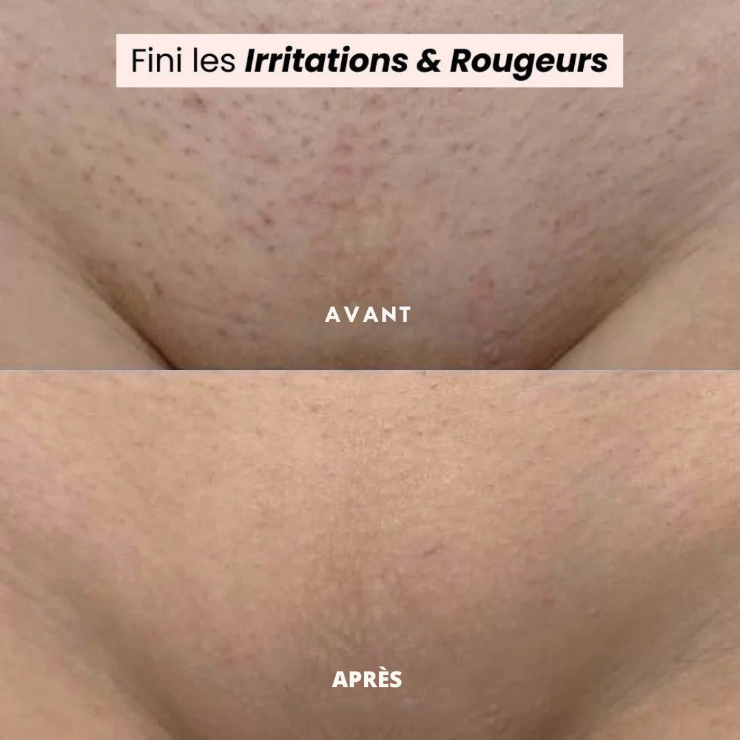 Sanfter elektrischer Epilierer