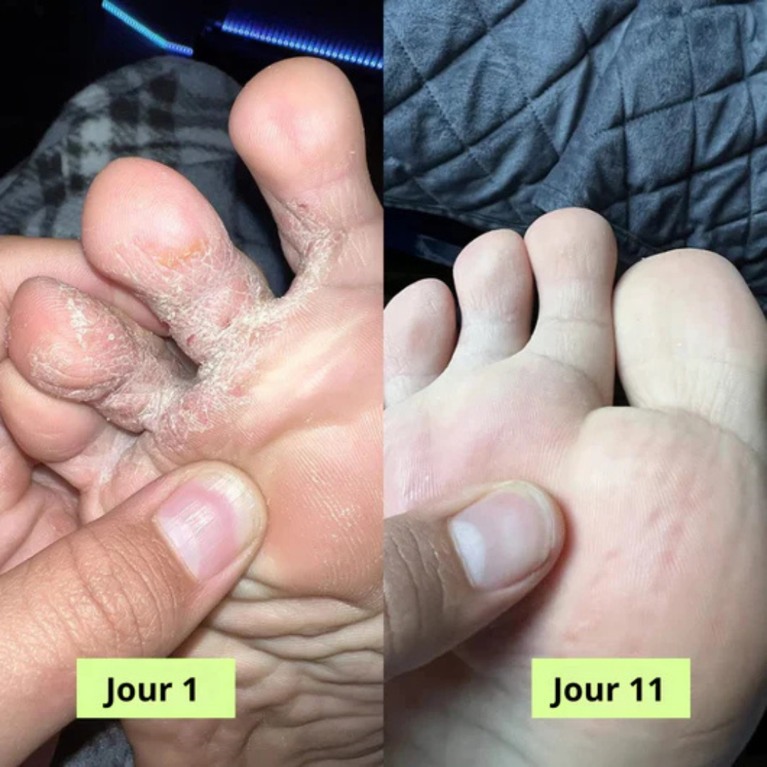 Savon Antifongique