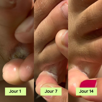 Savon Anti-Mycoses à l'Huile d'Arbre à Thé