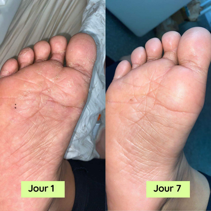 Savon Anti-Mycoses à l'Huile d'Arbre à Thé