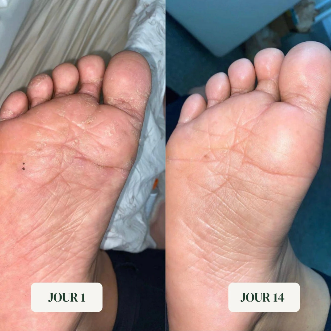 Savon anti-mycoses pieds