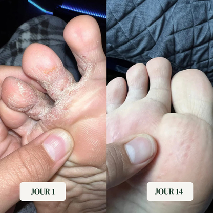 Savon anti-mycoses pieds