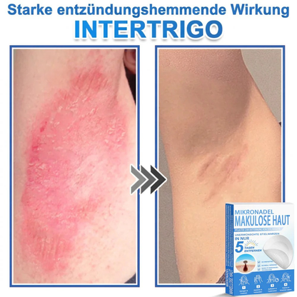 Patchs micro-aiguilles anti-boutons et imperfections visage