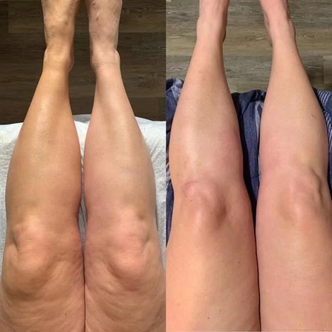 Appareil de Pressothérapie Jambes