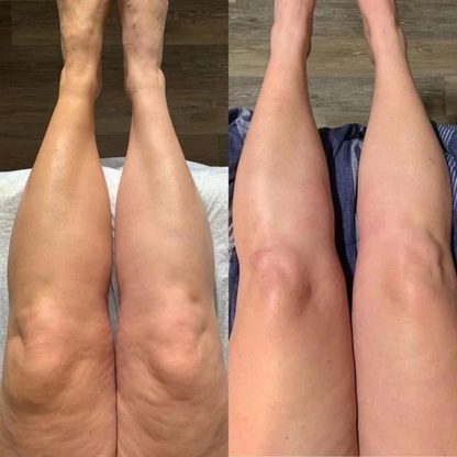 Appareil de Pressothérapie Jambes