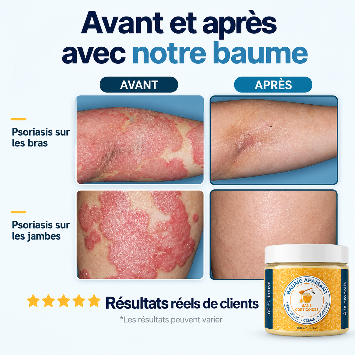 Baume Naturel Apaisant Psoriasis au Propolis